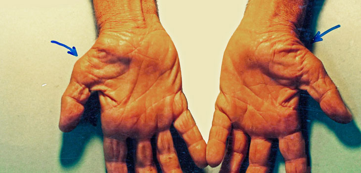 Shock! Carpal Tunnel Claims – Not Spine– Most Expensive
