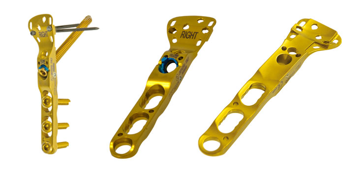 Orthofix’s Plating System Addresses Vascularity Damage