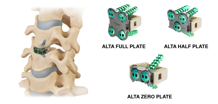 Lanx Claims First With Alta ACDF System