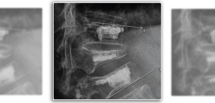 Osteolytic Vertebra Metastases Treated With Kiva