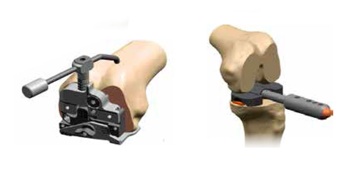 Smith & Nephew Showcases Knee, Technology