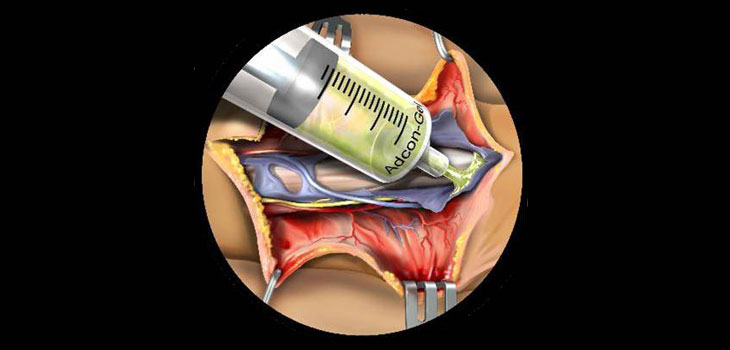 BiosCompass Acquires Anti-Adhesion Gel