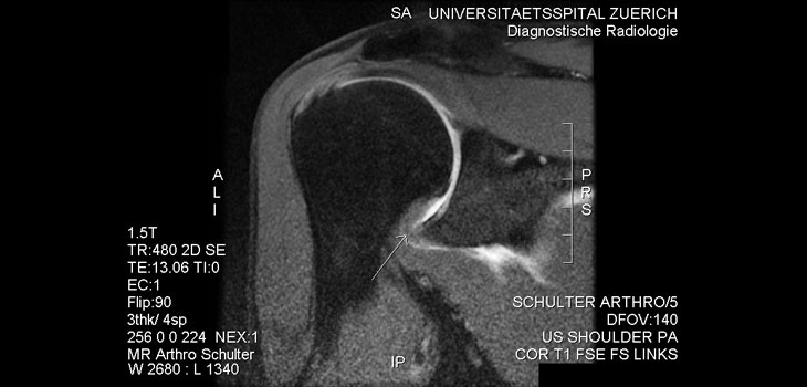 XIAFLEX: Positive Results for Adhesive Capsulitis