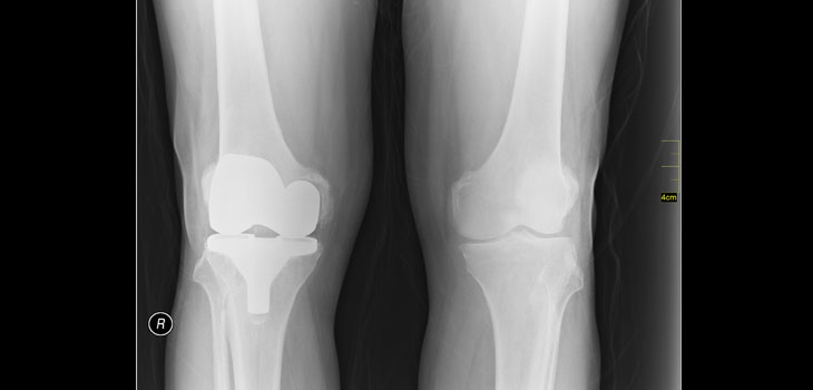 New Study Tackles Surgeon Technique and Implant Failure