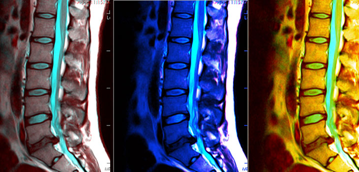 Number of Lumbar Spine MRIs Questioned