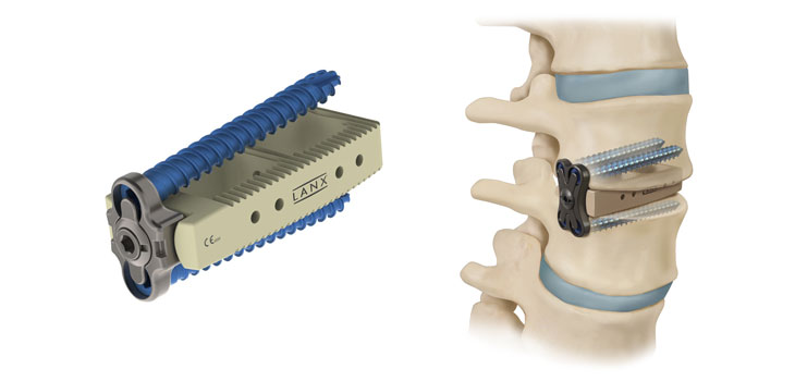 Lanx Claims First in Lateral Interbody Fusion