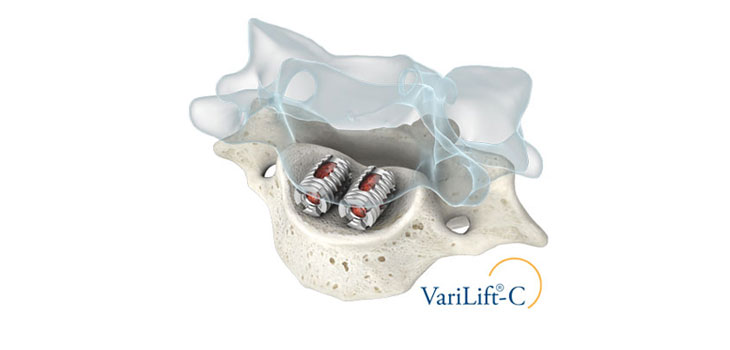 Wenzel Launches In Situ Expandable Fusion Device
