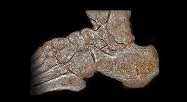India Surgeon Reconstructs Ankle Bones