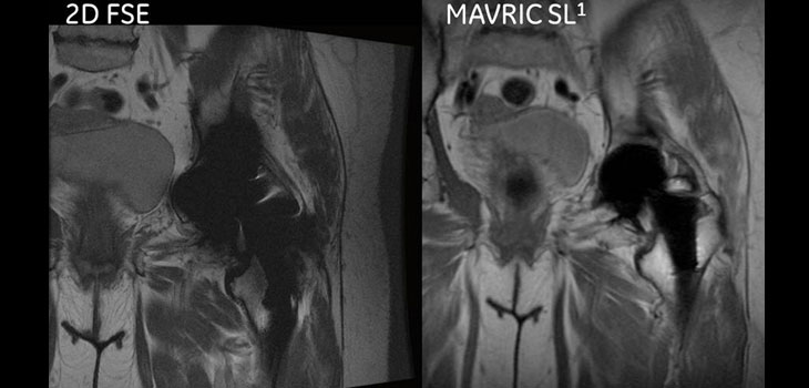 Early Detection of Synovitis with MRI Technique
