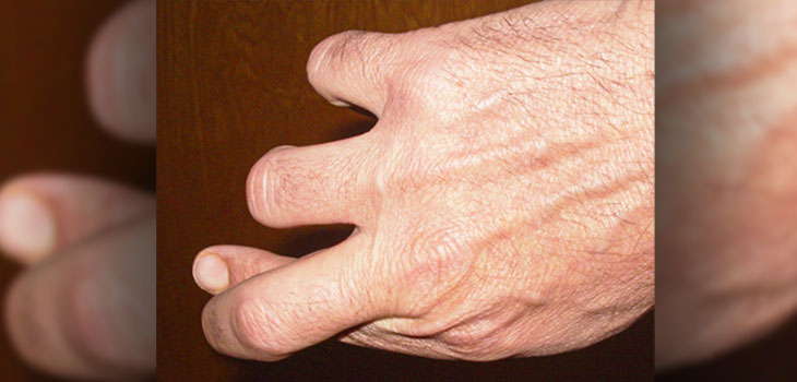 Hand Shape Related to Carpal Tunnel
