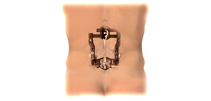 NuVasive Launches Smaller Incision Procedure