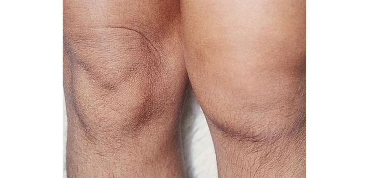Nerve-Growth Factor Important in Arthritis