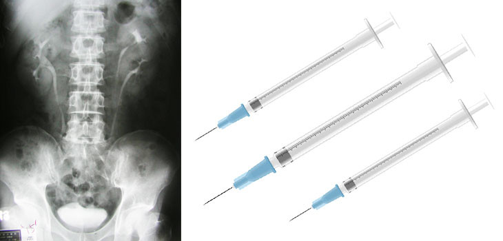 Steroid Injections: Approach With Caution