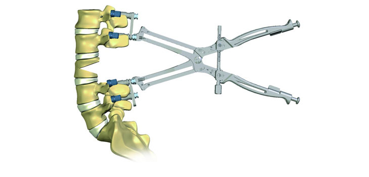 Medtronic Unveils Device to Restore Spine’s S-Shape