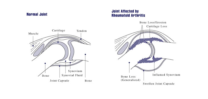 Studies Debunk Rheumatoid Arthritis Prognosis