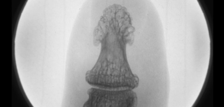 Stem Cells Under Nails Regenerate Fingers