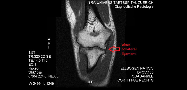 UCL Surgery Not an Athletic Career Buster