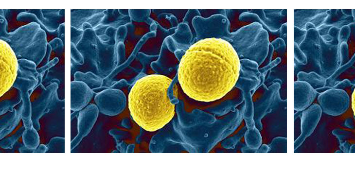 New Staph-Killing Compound for Osteomyelitis