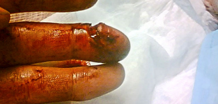 Fingertip Amputation and Limb Regeneration