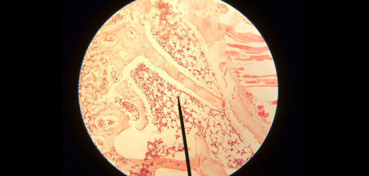 High Bone Marrow Fat a Risk Factor for Osteoporosis