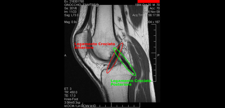 One ACLR Tear Leads to Another
