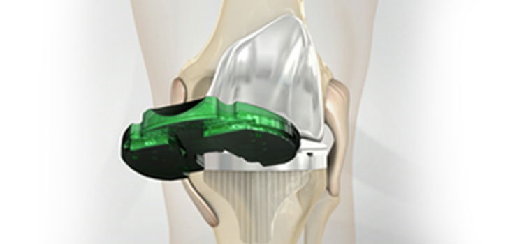 Verasense Knee System Cleared