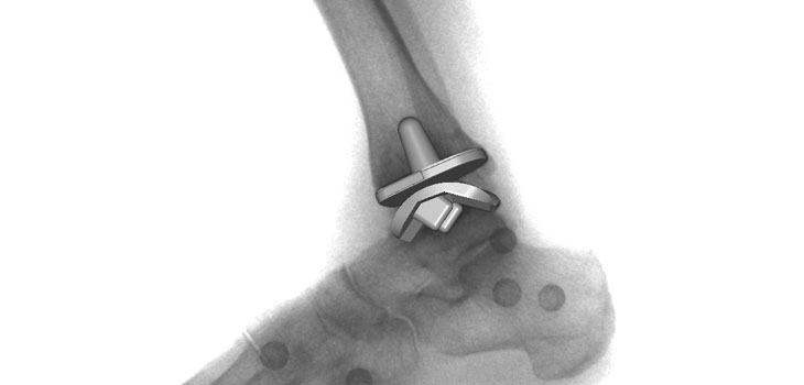 Complications Common After Ankle Replacement