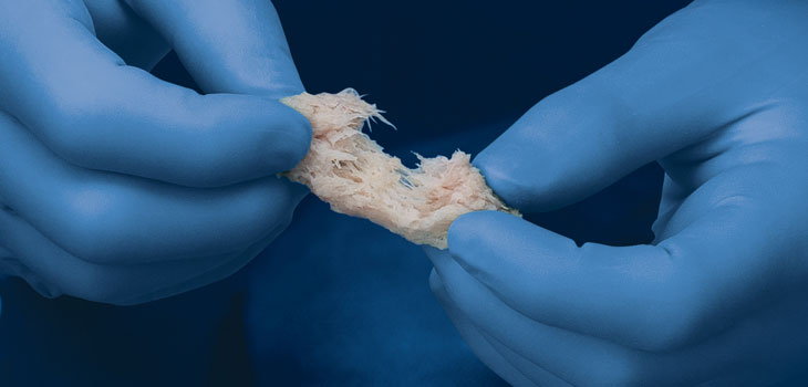 Orthofix Allograft Promises Better Handing