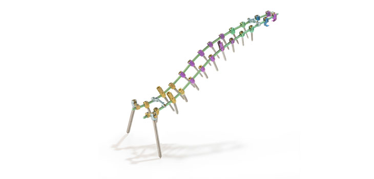 Zimmer Exclusive Distributor of SpineCraft’s APEX