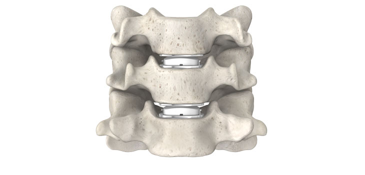 First and Only Two-Level Cervical Disc Approved in U.S.