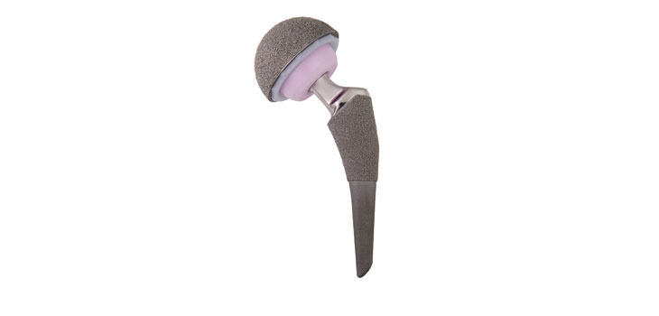 TaperFill Total Hip Implanted