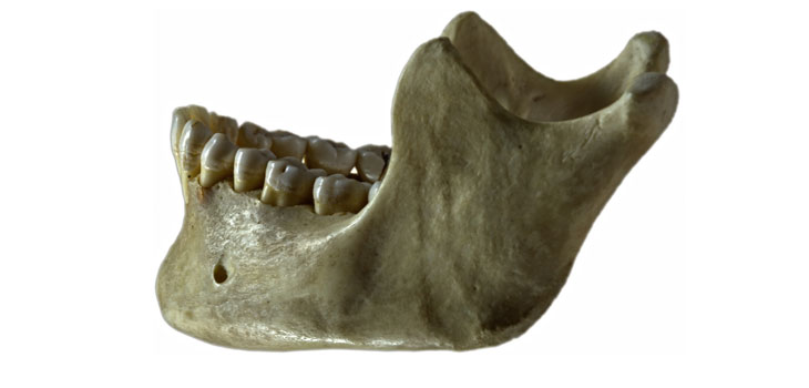 3D Printer Makes Human Jawbone