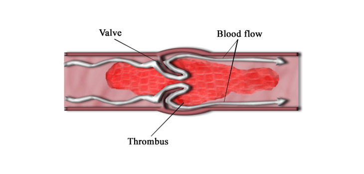RA Increases Risk of Blood Clots