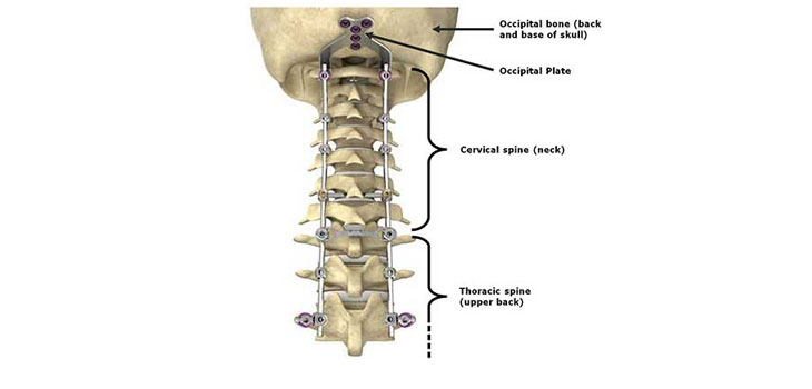 Australian Hazard Alert for Stryker Spine Plate