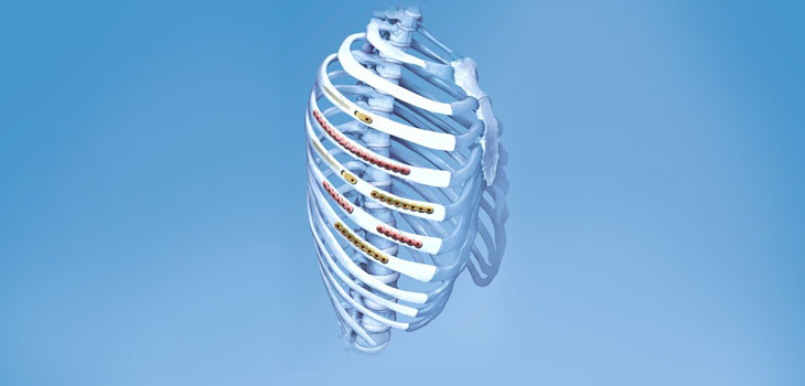 New Rib Fracture Instrumentation From DePuy Synthes