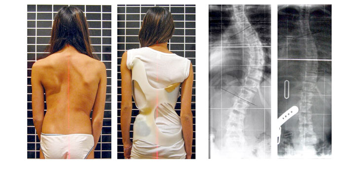 Near-Perfect Test for Infection in Synovial Fluid // Bracing May Trump Surgery for Scoliosis // and More!