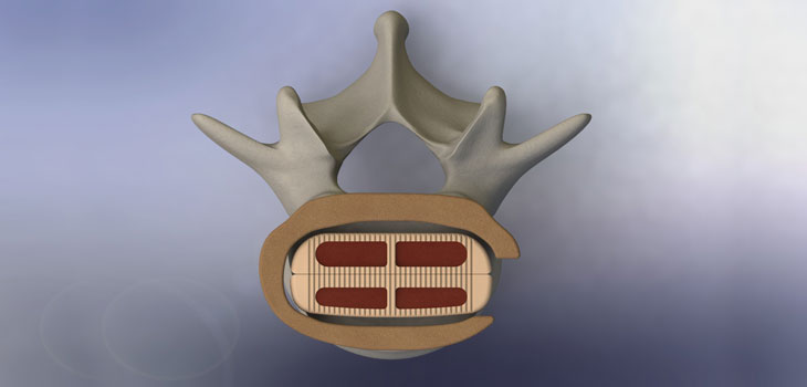 VTI’s InterFuse Lateral Gets FDA 510(k)