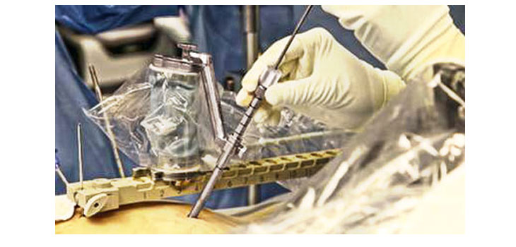 Mazor Robotics Performs 1st Deep Brain Stimulation