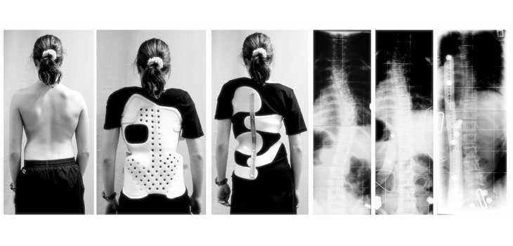 Got Scoliosis? Wear a Back Brace