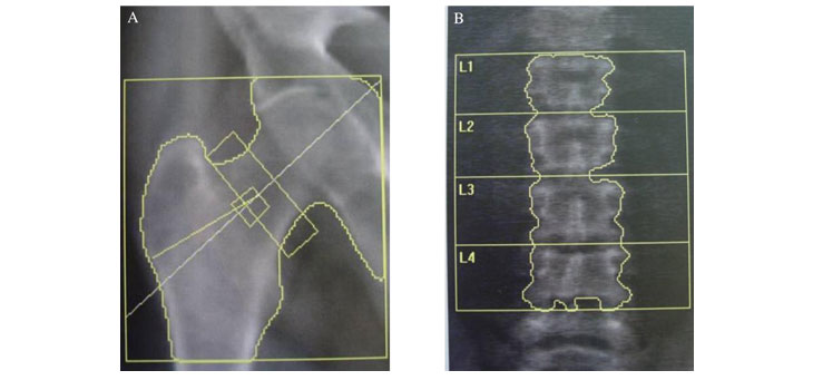 Repeating BMD Tests Shows Little Benefit
