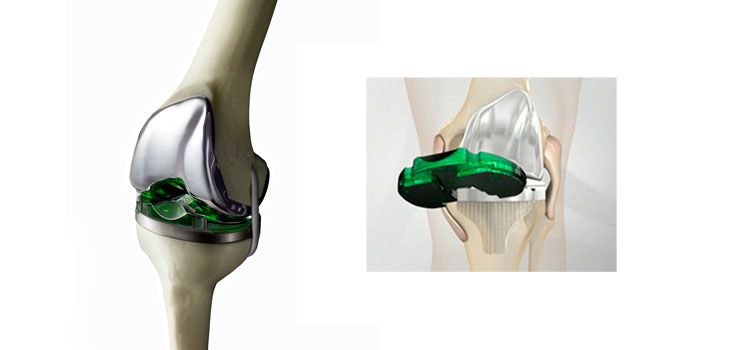Europe Approves Verasense Knee System