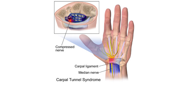 Carpal Tunnel Approaches Epidemic in Korea