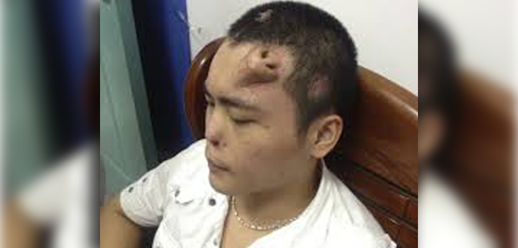 Chinese Surgeon Sculpts Nose on Forehead