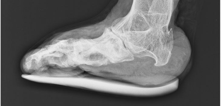 Bone Delayed Union Product Enters Trials