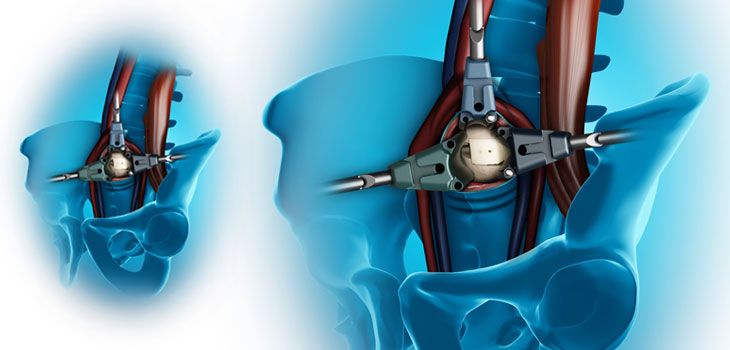 Medtronic Claims “First” in Lateral Access Spine Surgery