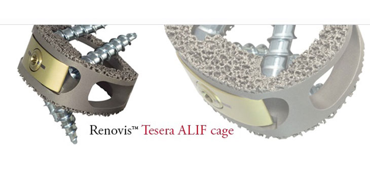 Renovis Surgical Launches Spinal Implant