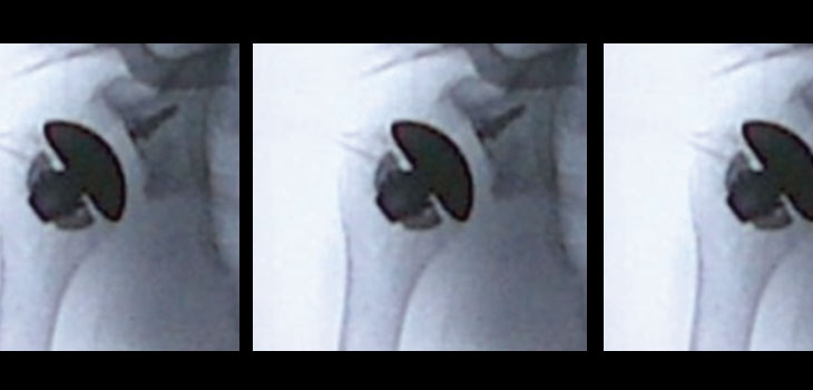 Biomet Implants First U.S. Stemless Shoulder