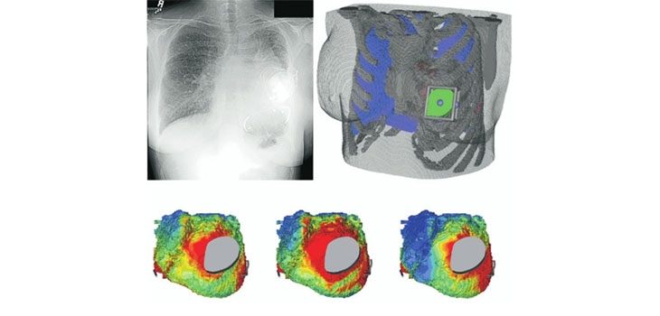 Total Joint Arthroplasty Lowers Cardiovascular Risk