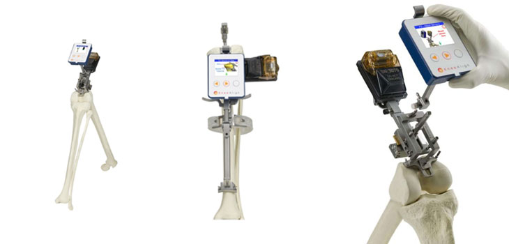 FDA Clears OrthAlign’s Handheld Navigation Device