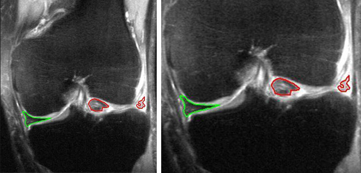 Knee OA Cell Therapy Trials in China